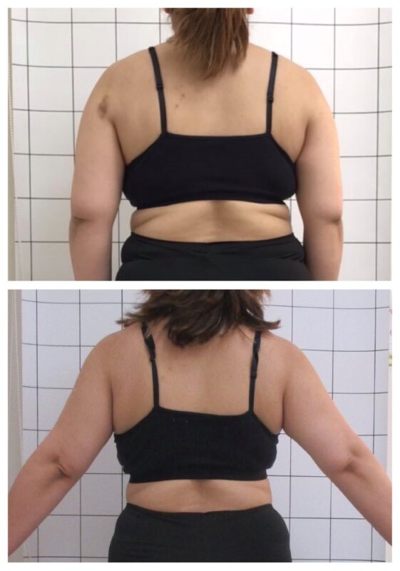 3か月でお背中スッキリ♢